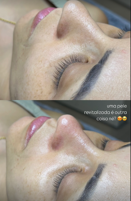 Resultado de tratamento estético 3